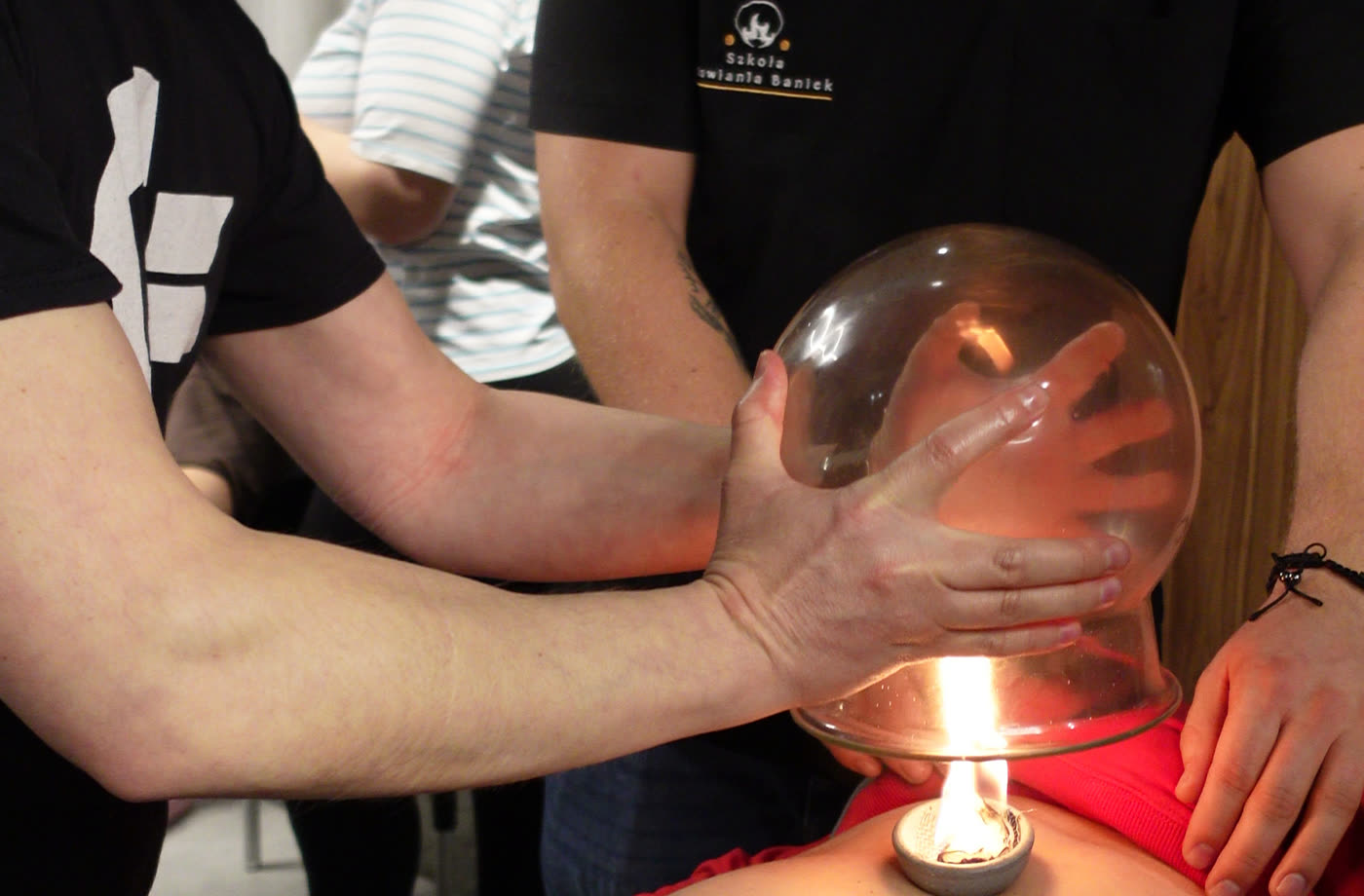 Large cupping glass during a treatment